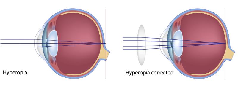 hyper-metropia-or-long-sightedness-fun-science